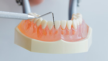 歯周ポケット検査の写真